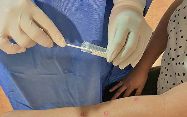 PRESERVA SALUD ESTATAL VIGILANCIA EPIDEMIOLÓGICA POR VIRUELA SÍMICA