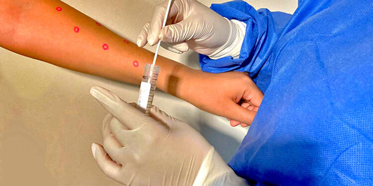 ANÁLISIS DE LABORATORIO CONFIRMA CASO DE VIRUELA SÍMICA EN BCS