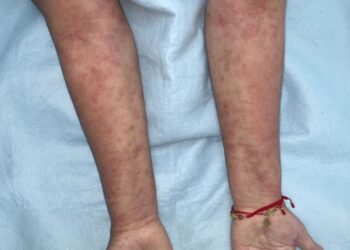 Recomienda IMSS mantener piel hidratada en pacientes con dermatitis atópica