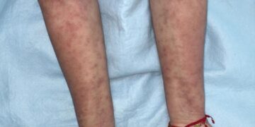 Recomienda IMSS mantener piel hidratada en pacientes con dermatitis atópica