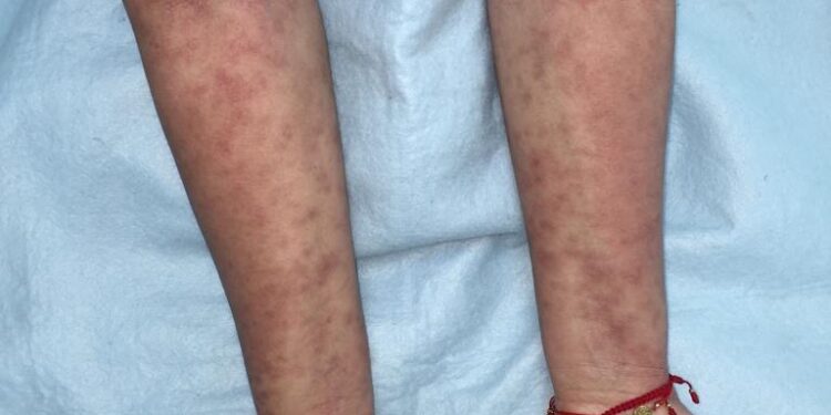 Recomienda IMSS mantener piel hidratada en pacientes con dermatitis atópica