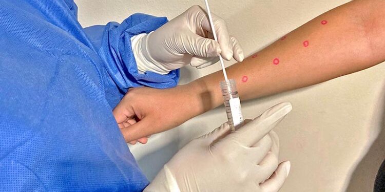 REPORTA SALUD ESTATAL UN NUEVO CASO DE VIRUELA SÍMICA