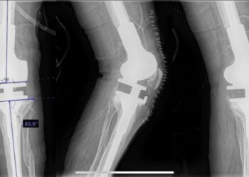 Especialistas del ISSSTE realizan cirugía de alta especialidad sin precedentes en BCS