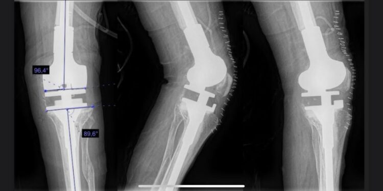Especialistas del ISSSTE realizan cirugía de alta especialidad sin precedentes en BCS