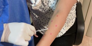 LA TOTALIDAD DE CASOS CONFIRMADOS POR MPOX EN BCS CURSAN LA ENFERMEDAD SIN COMPLICACIONES 