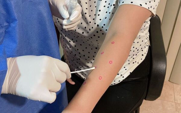 LA TOTALIDAD DE CASOS CONFIRMADOS POR MPOX EN BCS CURSAN LA ENFERMEDAD SIN COMPLICACIONES 