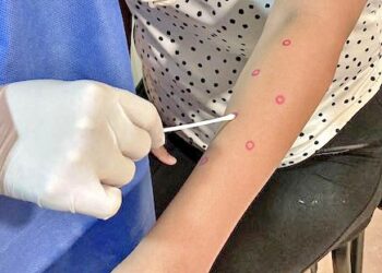 IMPARTIRÁN UNA NUEVA CAPACITACIÓN MÉDICA PARA DETECCIÓN Y MANEJO DE MPOX EN BCS 