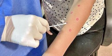 IMPARTIRÁN UNA NUEVA CAPACITACIÓN MÉDICA PARA DETECCIÓN Y MANEJO DE MPOX EN BCS 