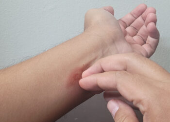 Recomienda IMSS Baja California Sur protegerse contra la picadura de mosco para prevenir el dengue 