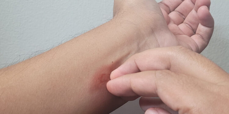 Recomienda IMSS Baja California Sur protegerse contra la picadura de mosco para prevenir el dengue 