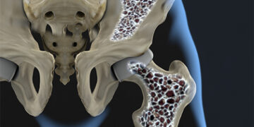 Biotecnología y osteoporosis: avances en Baja California Sur para combatir esta “enfermedad silenciosa”