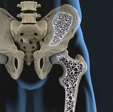 Biotecnología y osteoporosis: avances en Baja California Sur para combatir esta “enfermedad silenciosa”
